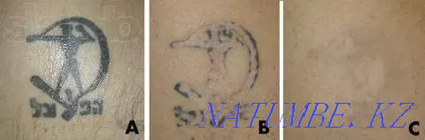 LASER REMOVAL! Tattoos and tattooing of eyebrows!! neodymium laser. Petropavlovsk - photo 8