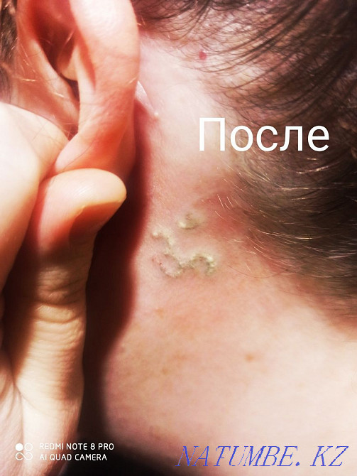 Tattoo removal / permanent makeup Almaty - photo 4