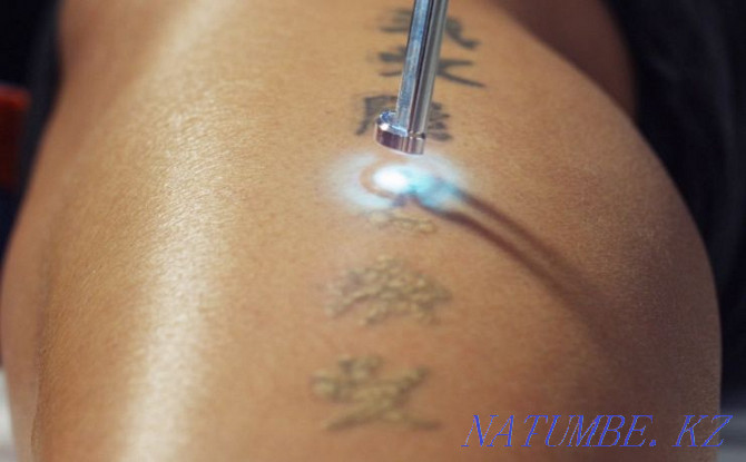 Laser tattoo removal Shymkent - photo 7