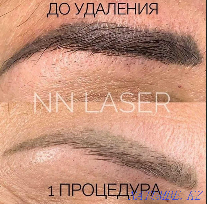 Laser tattoo removal Shymkent - photo 2