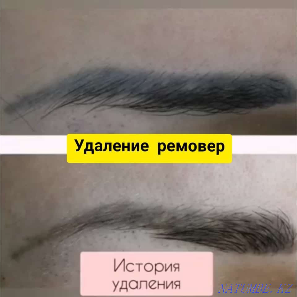 Laser tattoo removal Shymkent - photo 8