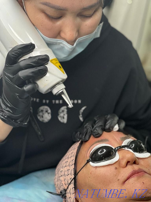 Laser tattoo removal Shymkent - photo 1