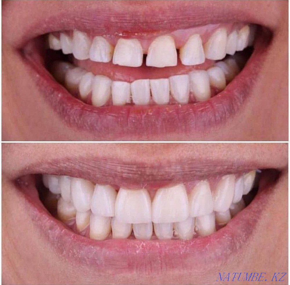 Круглосуточная стоматология Нур-султан 24/7 . Акция!!! Скидка до-40% Астана - изображение 1