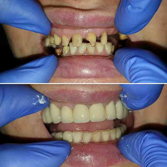 Лечение зубов, удаление, протезирование Семей