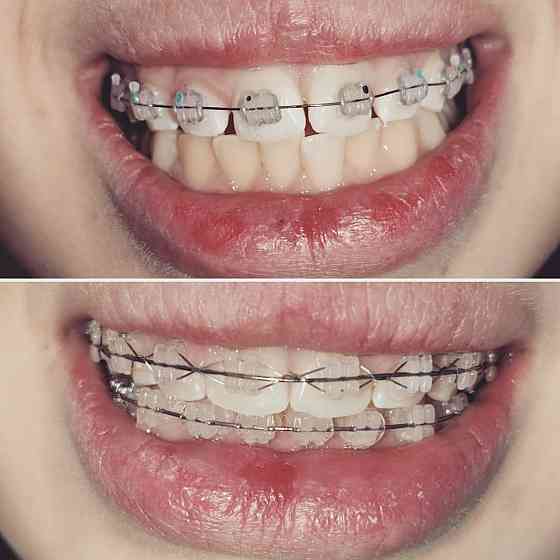 Лечение зубов, удаление, протезирование Семей