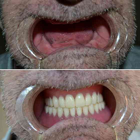 Лечение зубов, удаление, протезирование Semey