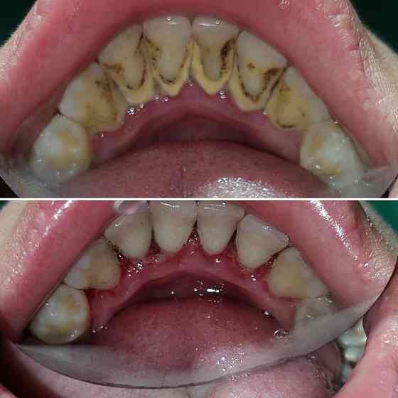 Лечение зубов, удаление, протезирование Semey