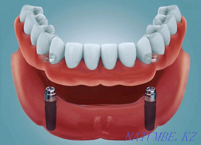 Лечение зубов, удаление, протезирование Семей - изображение 7