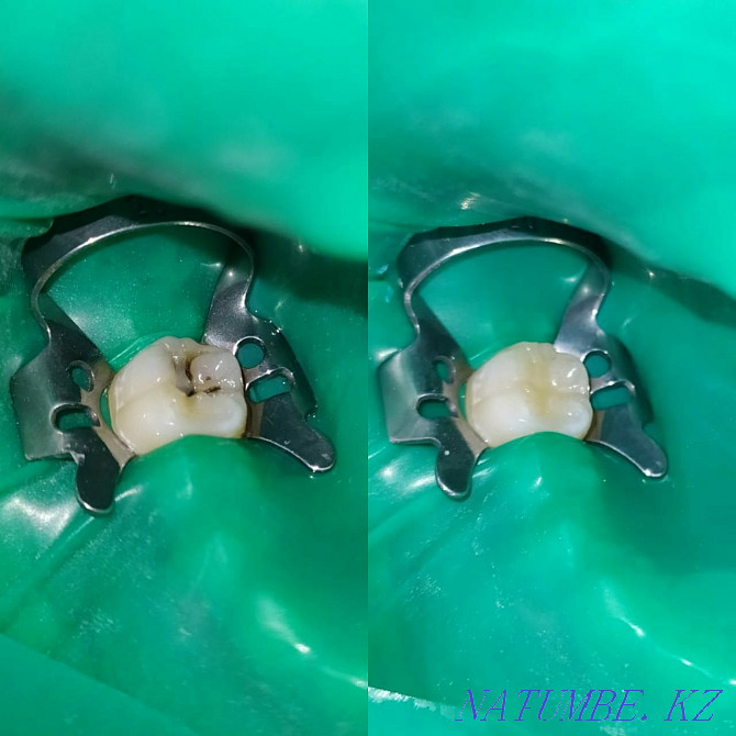 Лечение зубов, удаление, протезирование Семей - изображение 5