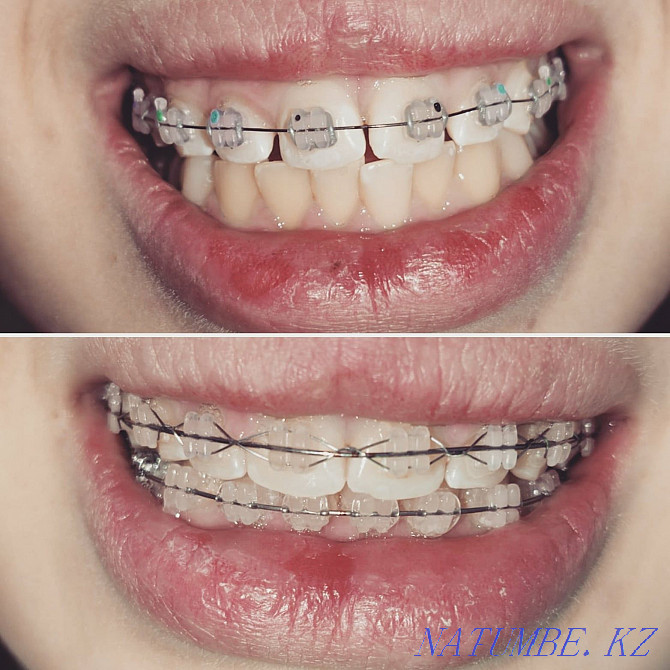 Лечение зубов, удаление, протезирование Семей - изображение 6