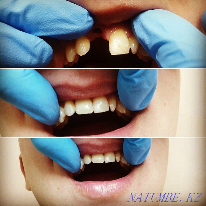 Лечение зубов, удаление, протезирование Семей - изображение 8