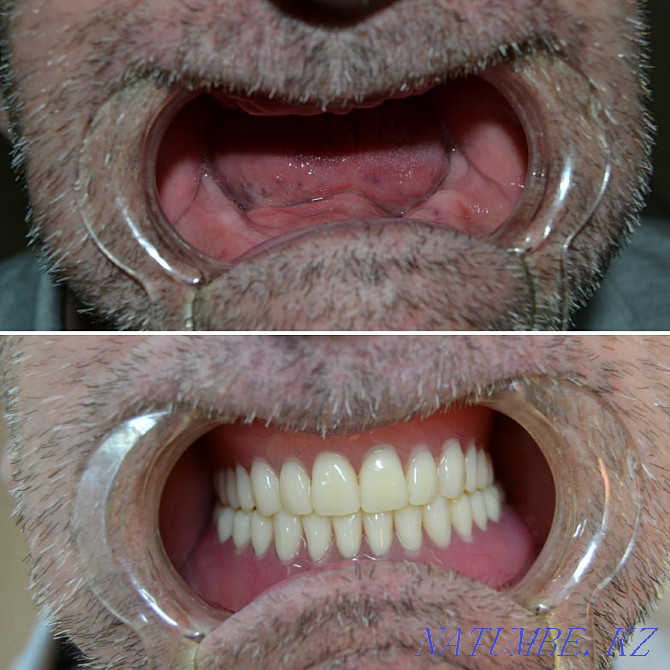 Лечение зубов, удаление, протезирование Семей - изображение 3