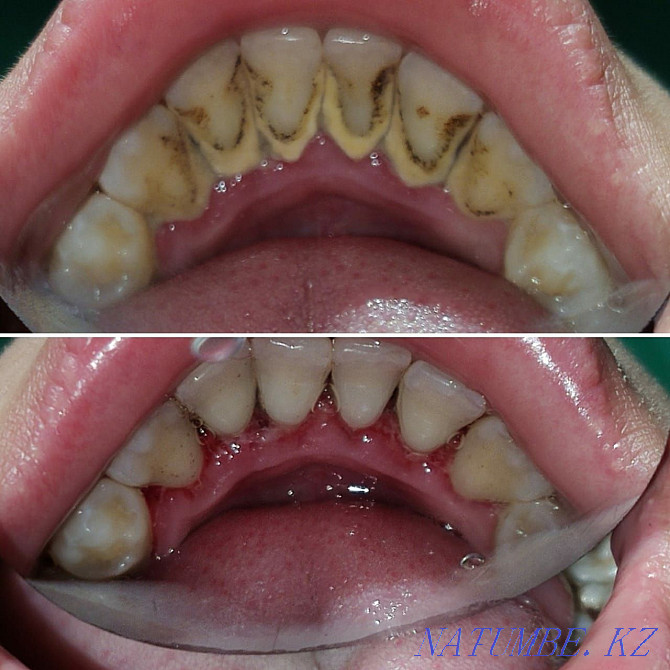 Лечение зубов, удаление, протезирование Семей - изображение 4