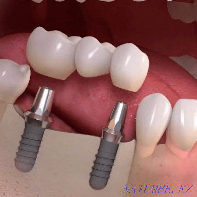 За счет пенсионных накоплений имплантация и протезирование Алматы - изображение 1