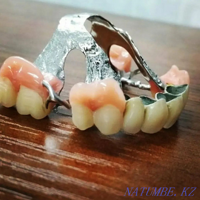 Изготовление и ремонт зубных протезов Алматы - изображение 6