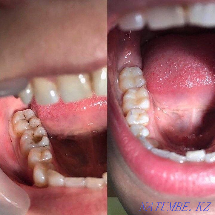 ??????All types of dental services by UAPF pension transfer Almaty - photo 5