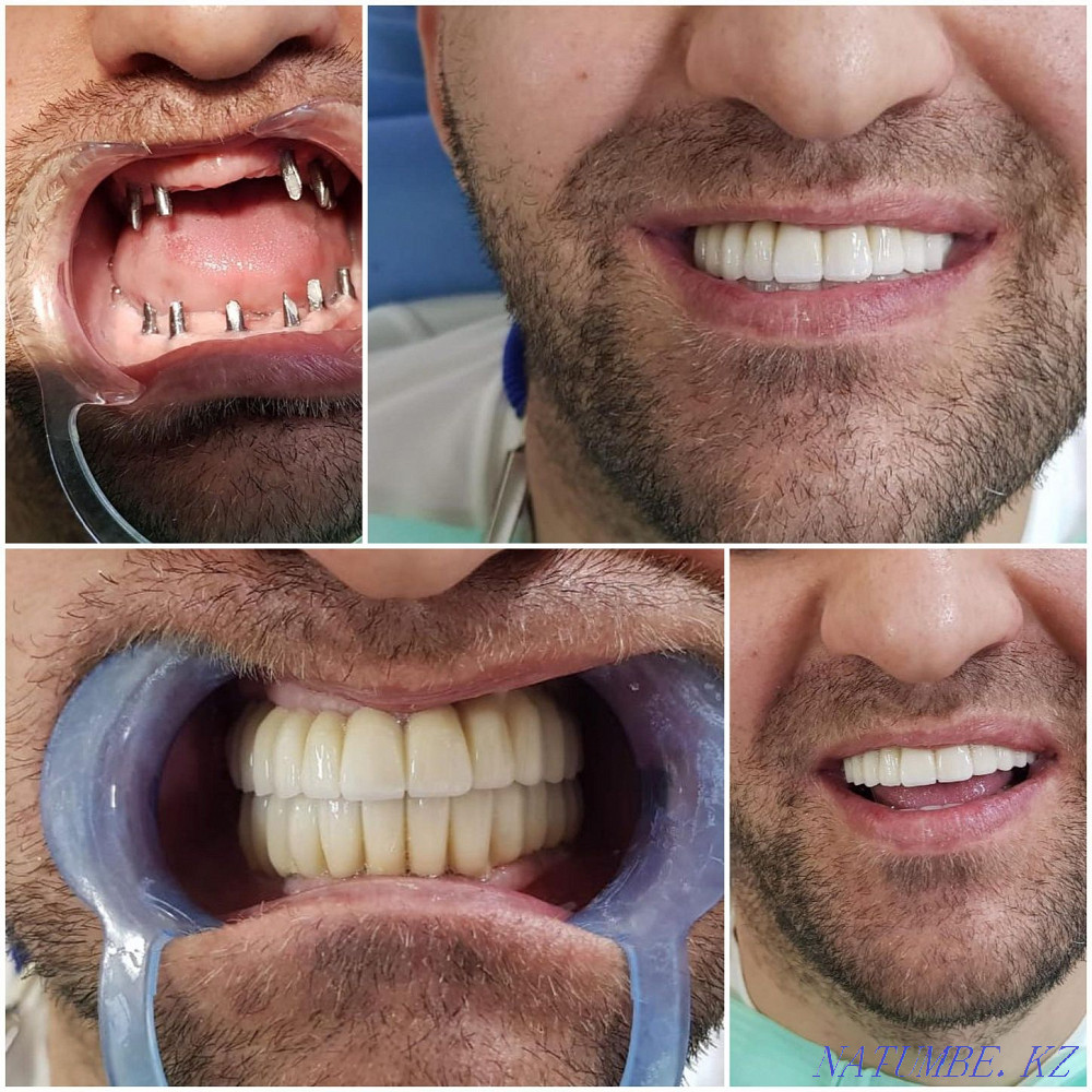 Несъемные протезы на Имплантах. Стоматология Алматы - изображение 8