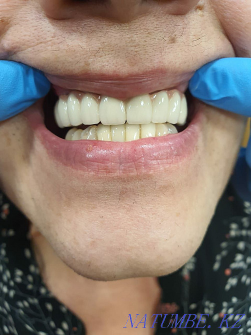 Несъемные протезы на Имплантах. Стоматология Алматы - изображение 4