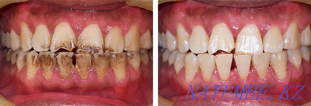 Стоматология. Чистка зубов 6000тг вместо 15000тг Шымкент - изображение 1