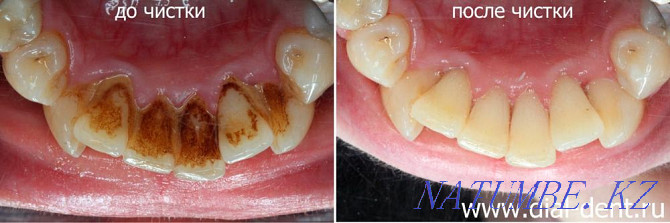 Стоматология. Чистка зубов 6000тг вместо 15000тг Шымкент - изображение 2