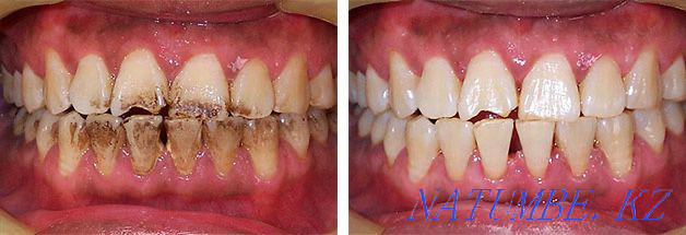 Dentistry. Teeth cleaning 6000tg instead of 15000tg Shymkent - photo 1