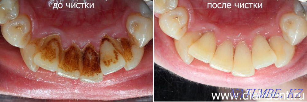 Dentistry. Teeth cleaning 6000tg instead of 15000tg Shymkent - photo 2