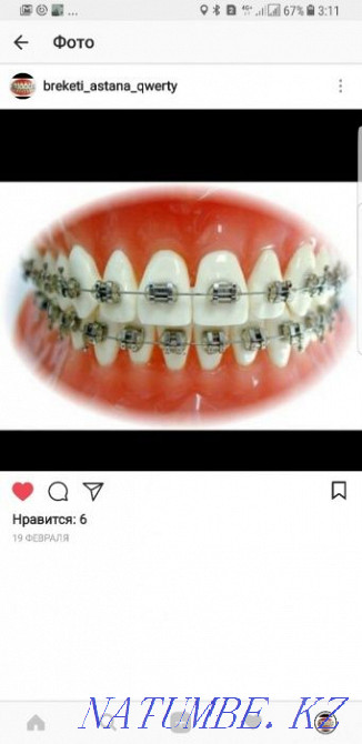 Чистка бесплатно при установки металлического брекета АКЦИЯ-35000 тг. Астана - изображение 1