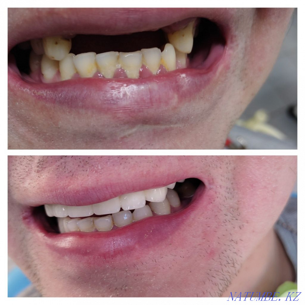 Стоматологиялық қызметтер  Қостанай  - изображение 6