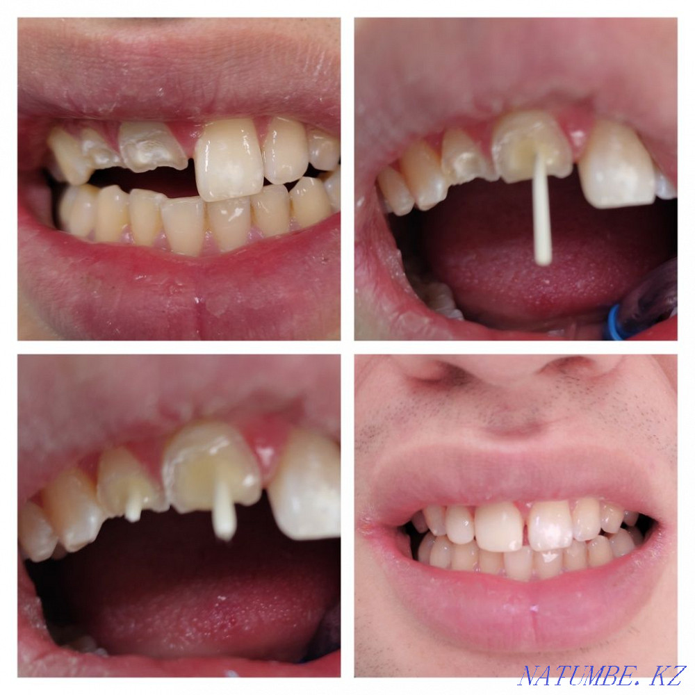 Стоматологиялық қызметтер  Қостанай  - изображение 4