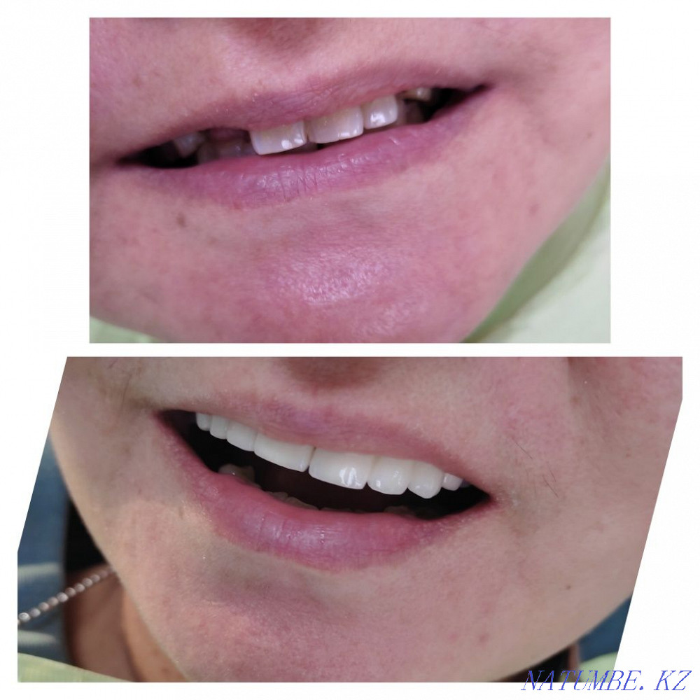 Стоматологиялық қызметтер  Қостанай  - изображение 5