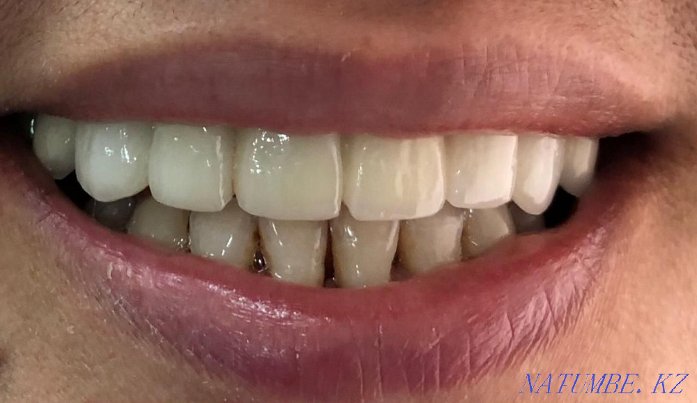 На все виды стоматологических услуг скидки Астана - изображение 4