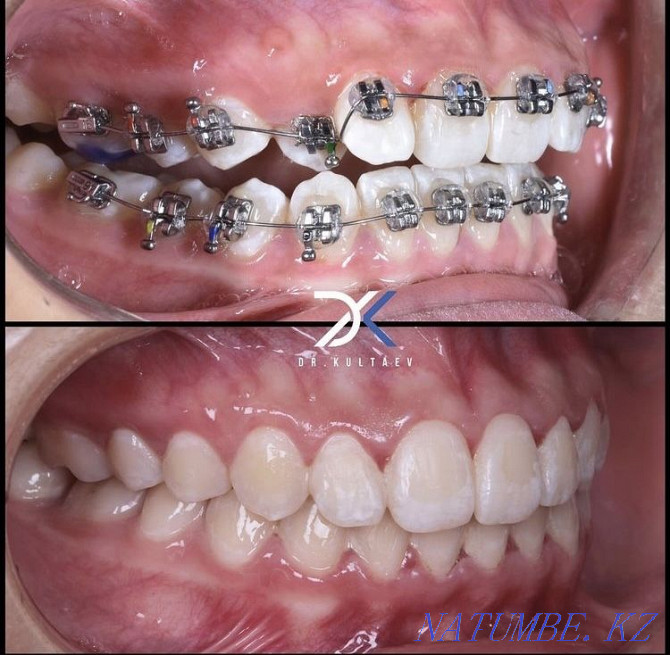 Брекет, ортодонт дәрігері 29000тг Шымкент - изображение 2