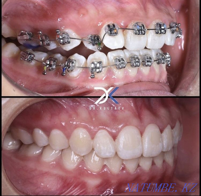 Брекеты, ортодонт 29000тг Шымкент - изображение 2