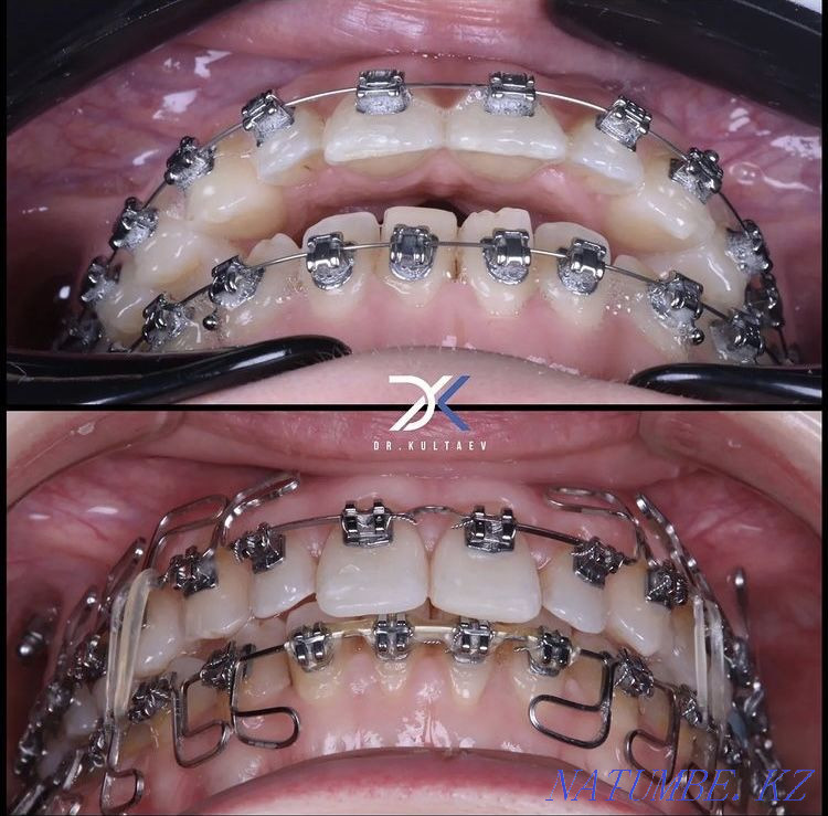 Брекеты, ортодонт 29000тг Шымкент - изображение 3