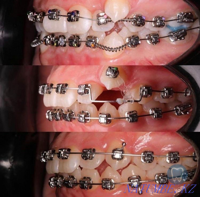 Dental services at affordable prices. Removing from 5 thousand Astana - photo 3