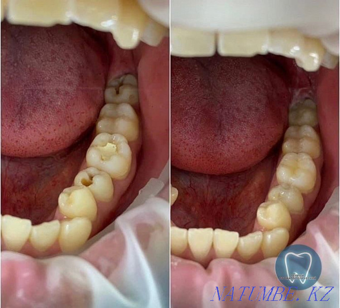 Dental services at affordable prices. Removing from 5 thousand Astana - photo 1