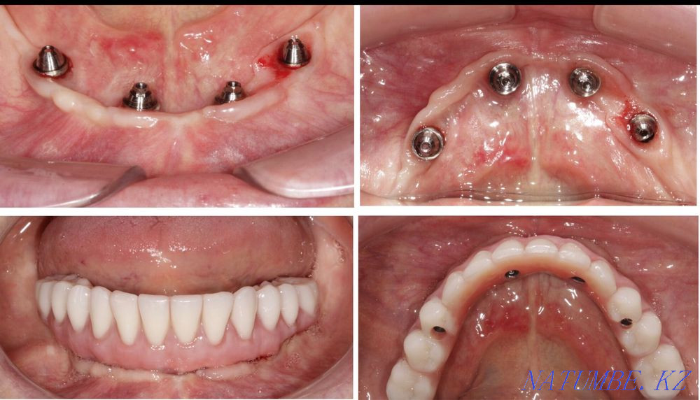 Dental services at affordable prices. Removing from 5 thousand Astana - photo 4