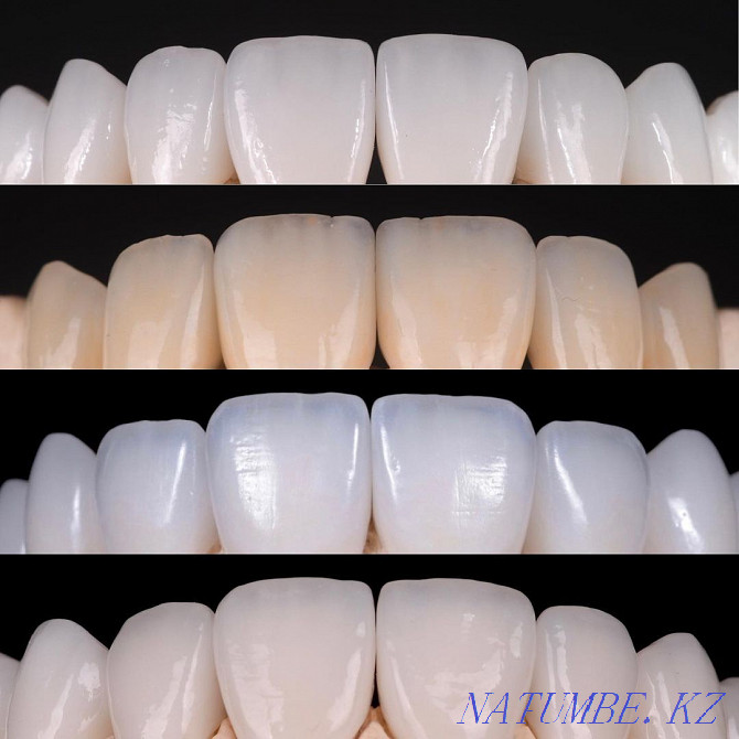 Zirconia crowns Almaty - photo 1