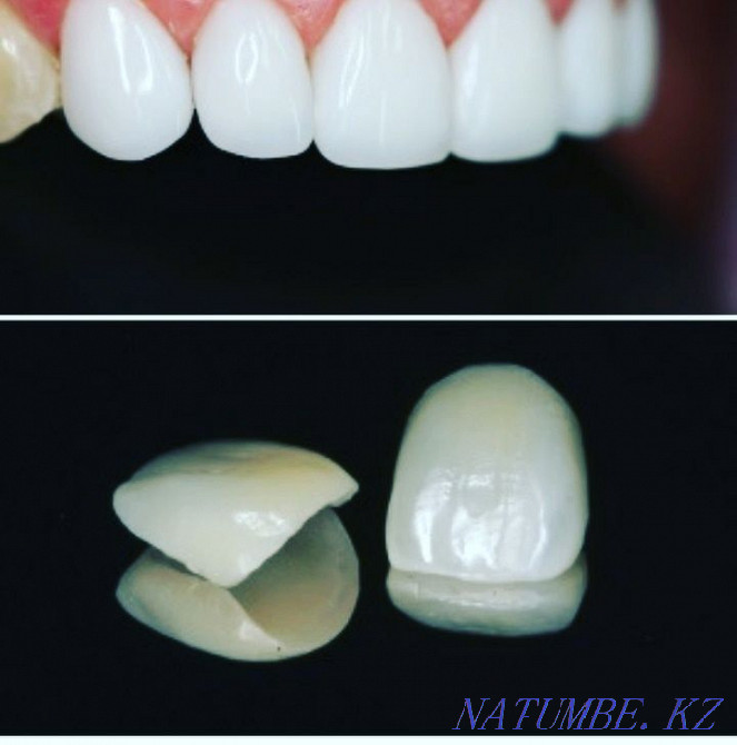 Implantation from 70 000tg Almaty - photo 2