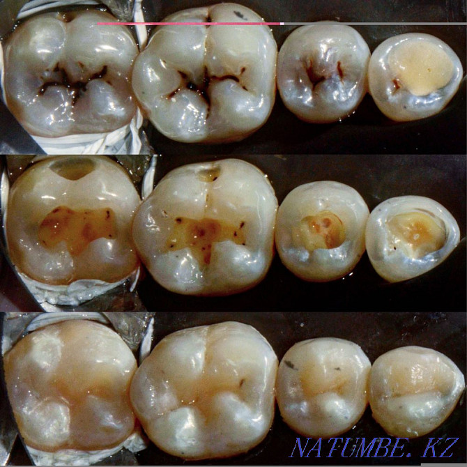 Dentist/veneers/implantation Astana - photo 2
