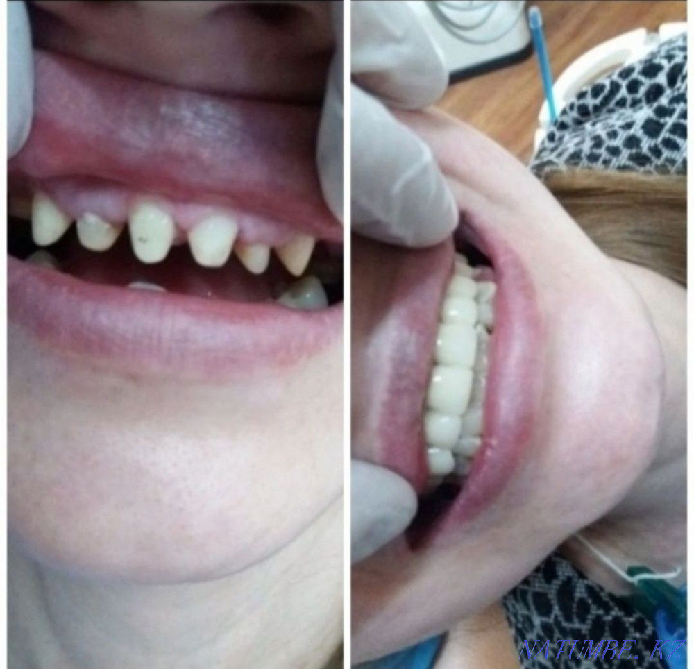 Имплант. Металл керамика 12500тг. Жеңілдік  Алматы - изображение 7