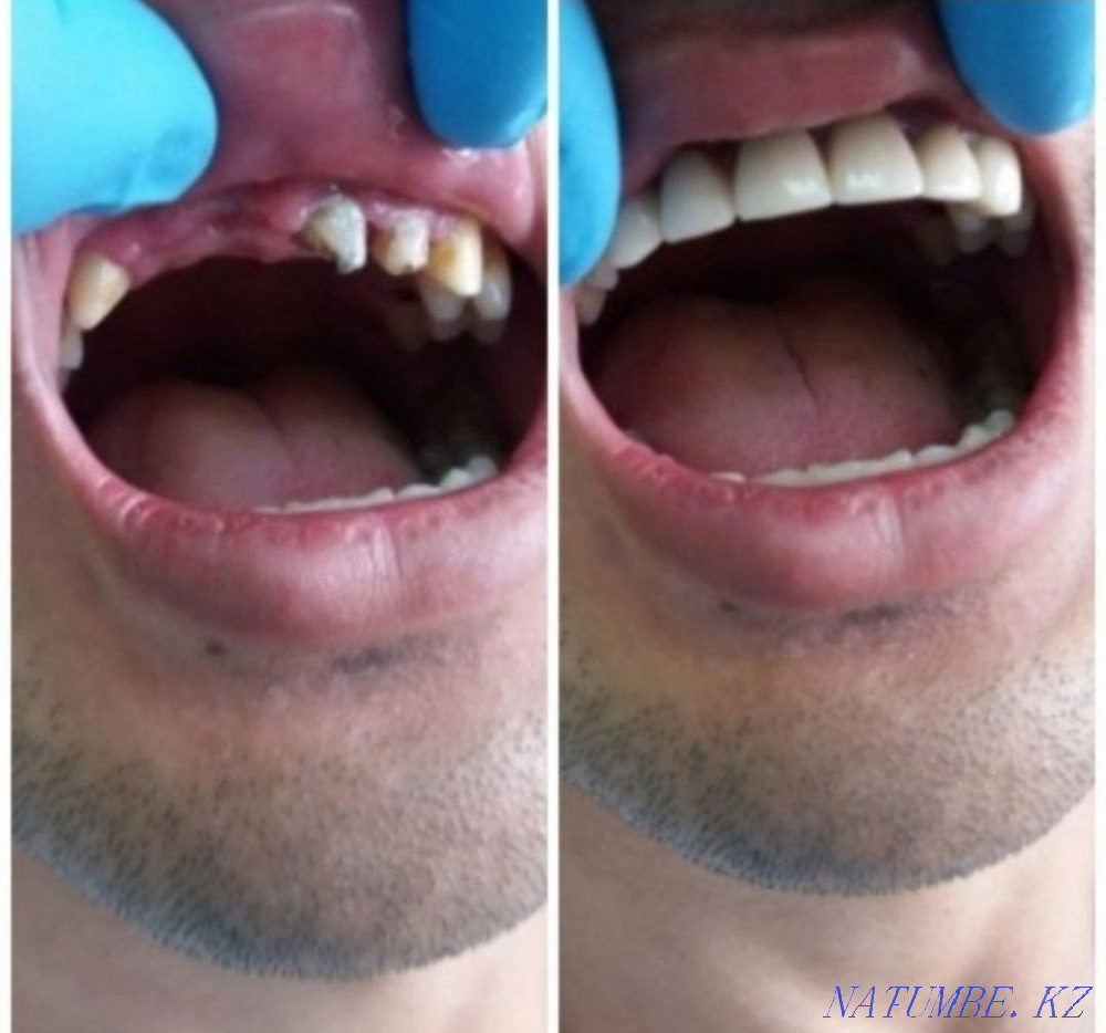 Имплант. Металл керамика 12500тг. Жеңілдік  Алматы - изображение 8