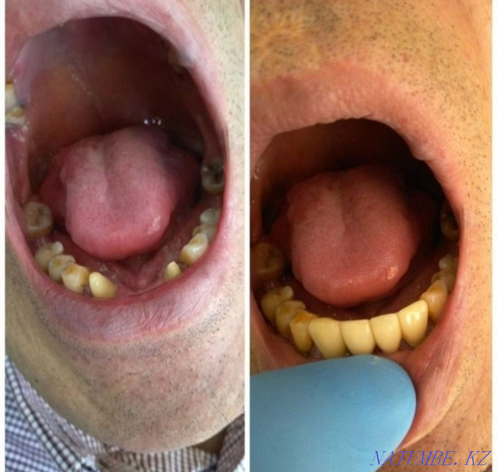 Имплант. Металл керамика 12500тг. Жеңілдік  Алматы - изображение 4
