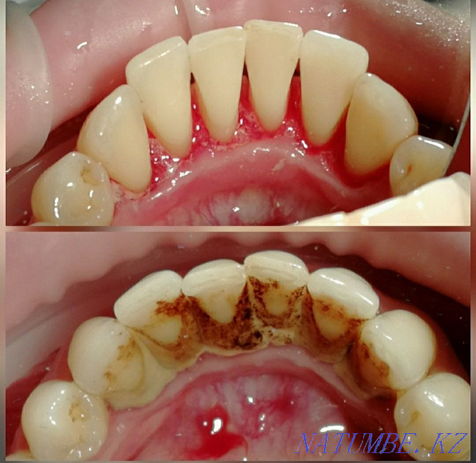 Имплантатсия. АКЦИЯ 80% тахфиф. Дар стоматология Алматы - photo 5