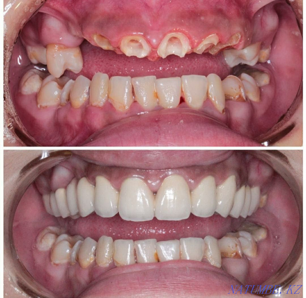 Implant. ACTION 80% discount. In dentistry Almaty - photo 7