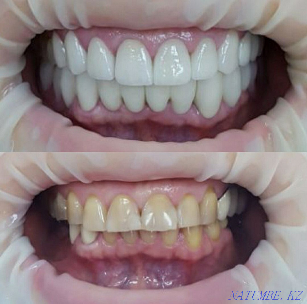 Implant. ACTION 80% discount. In dentistry Almaty - photo 8