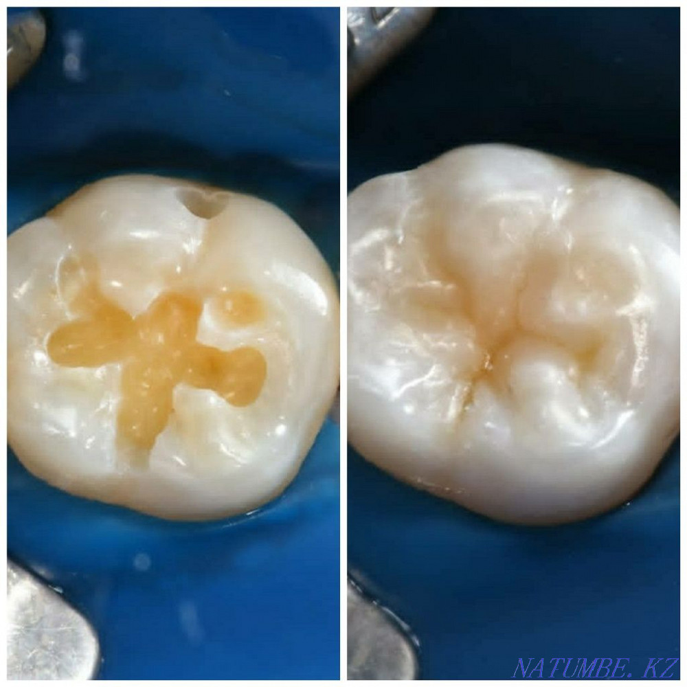 Implant. ACTION 80% discount. In dentistry Almaty - photo 3