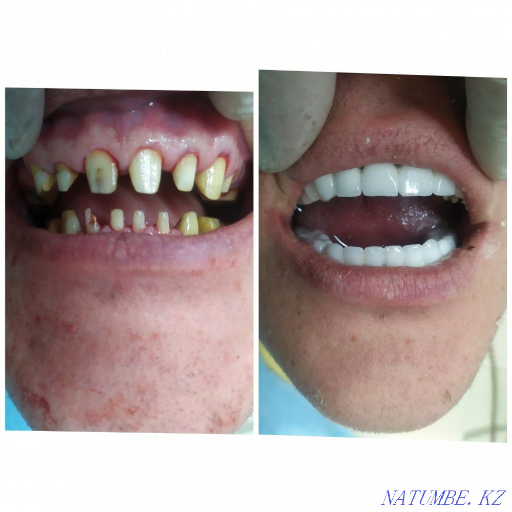 Implant. ACTION 80% discount. In dentistry Almaty - photo 4