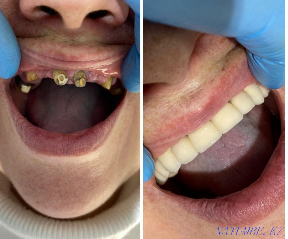 Implant. ACTION 80% discount. In dentistry Almaty - photo 2