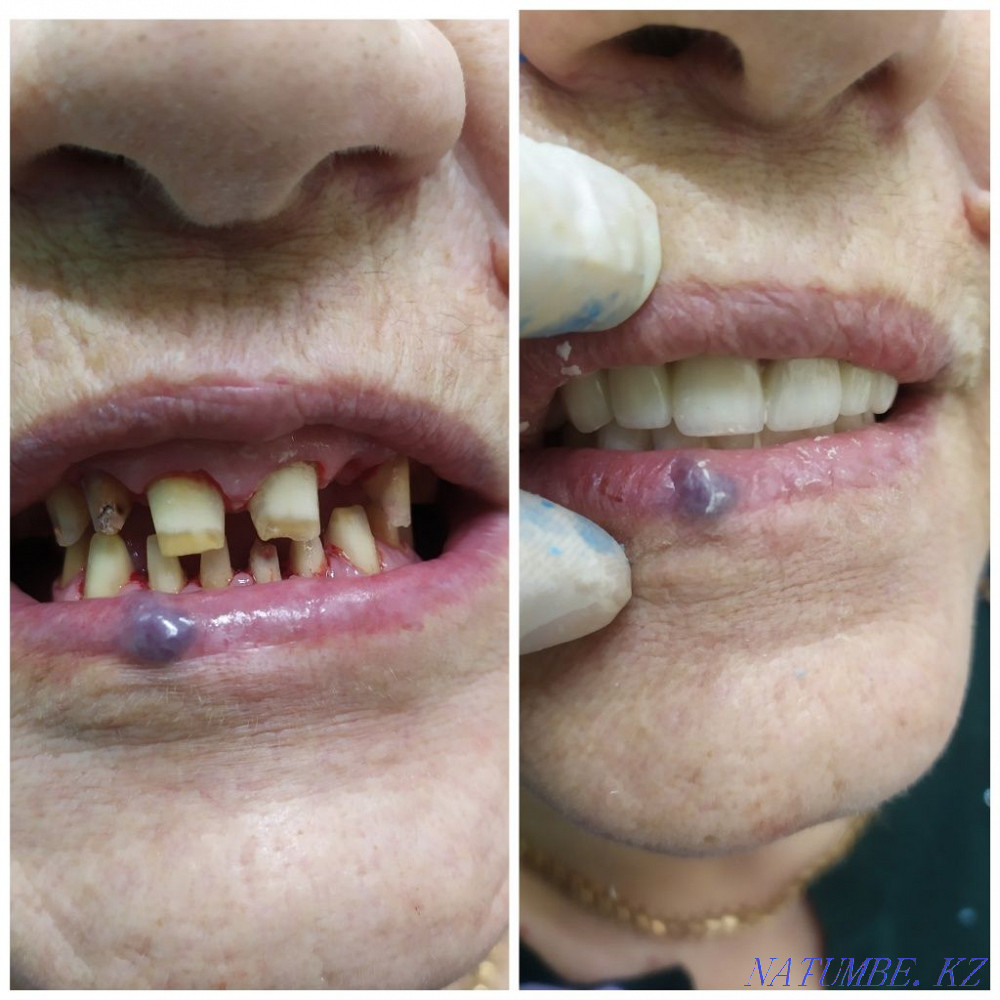 Implant. ACTION 80% discount. In dentistry Almaty - photo 1